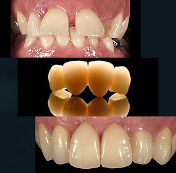 اصلاح شکل و فرم دندان ها