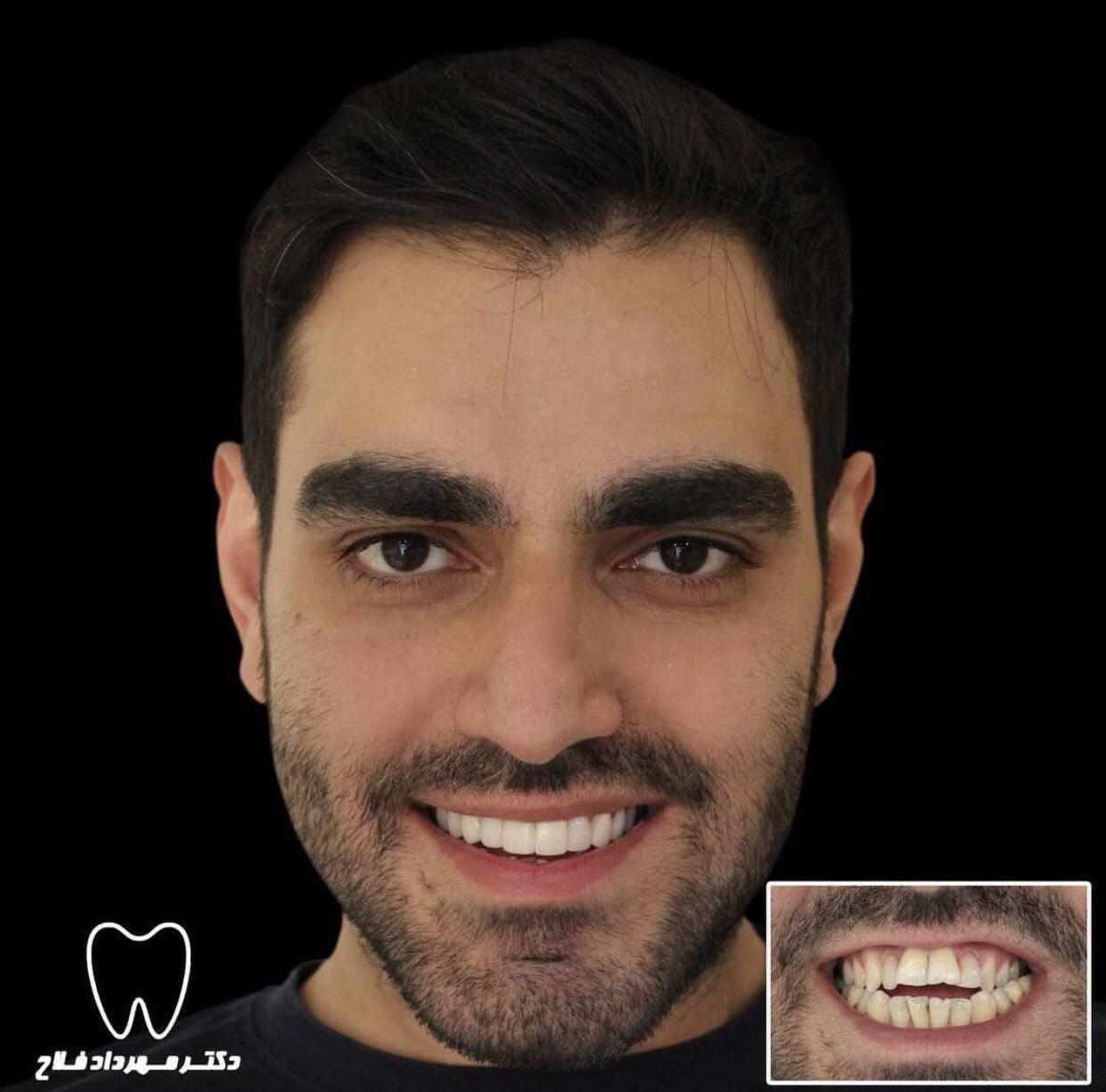 اصلاح مال اکلوژن با ارتودنسی