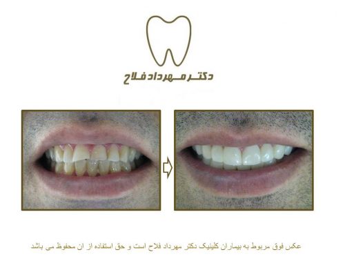 گالری عکس قبل و بعد اصلاح شکل و فرم دندان