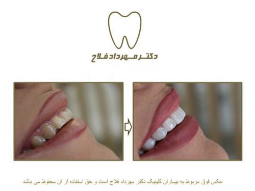 گالری عکس قبل و بعد اصلاح تغییر رنگ دندان