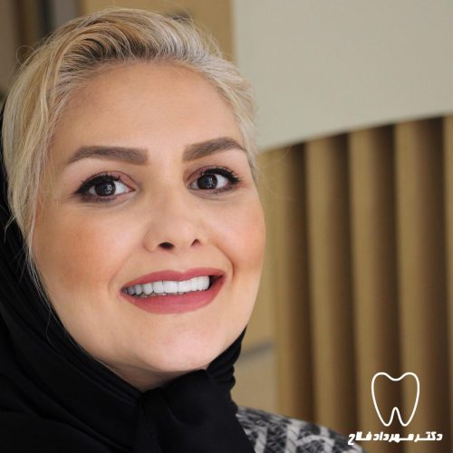 لمینت بريليانس