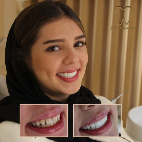 بستن فاصله میان دندان ها