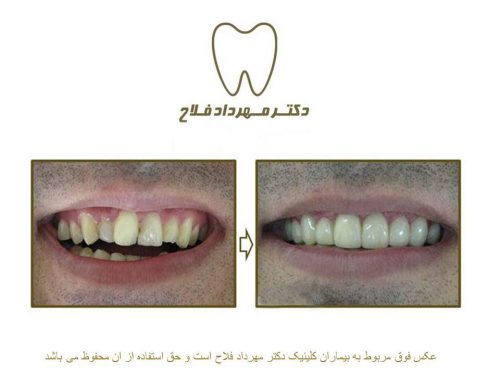 گالری عکس اصلاح نامرتبی دندان