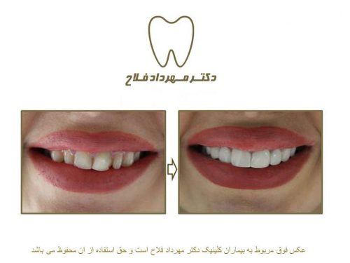 گالری عکس اصلاح نامرتبی دندان