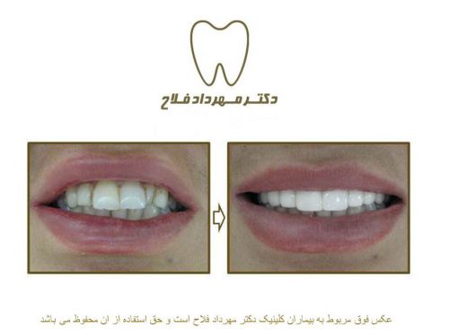 گالری عکس قبل و بعد اصلاح شکل و فرم دندان