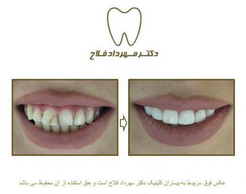 گالری عکس قبل و بعد اصلاح تغییر رنگ دندان