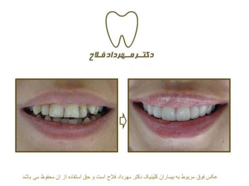 گالری عکس اصلاح نامرتبی دندان