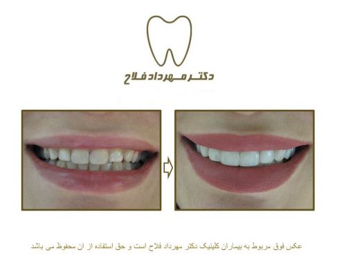 گالری عکس قبل و بعد اصلاح تغییر رنگ دندان