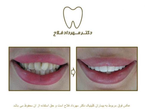 گالری عکس اصلاح نامرتبی دندان