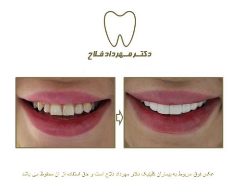 گالری عکس قبل و بعد اصلاح شکل و فرم دندان