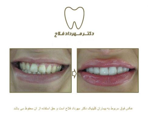گالری عکس قبل و بعد اصلاح شکل و فرم دندان