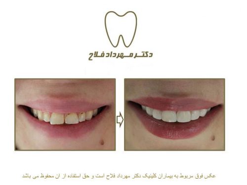 گالری عکس قبل و بعد اصلاح شکل و فرم دندان