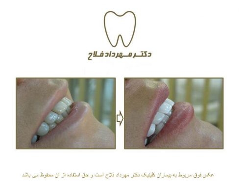 گالری عکس قبل و بعد اصلاح تغییر رنگ دندان