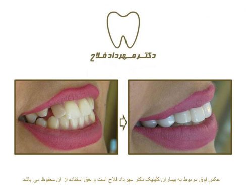 گالری عکس اصلاح نامرتبی دندان