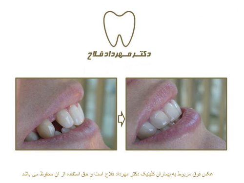 گالری عکس قبل و بعد اصلاح فاصله بین دندان
