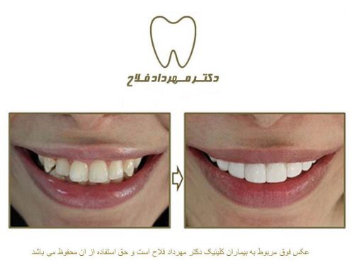 گالری عکس اصلاح نامرتبی دندان