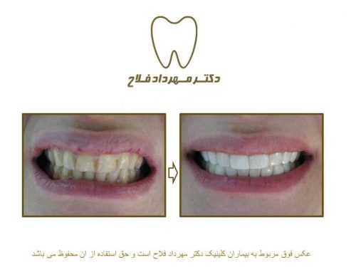 گالری عکس قبل و بعد اصلاح تغییر رنگ دندان