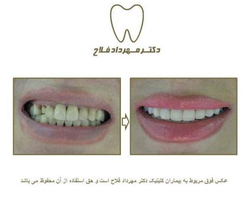 گالری عکس روکش تمام سرامیک
