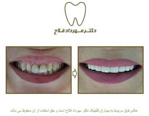 گالری عکس روکش تمام سرامیک