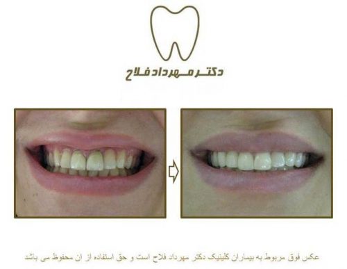 گالری عکس روکش تمام سرامیک