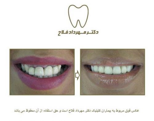 گالری عکس روکش تمام سرامیک