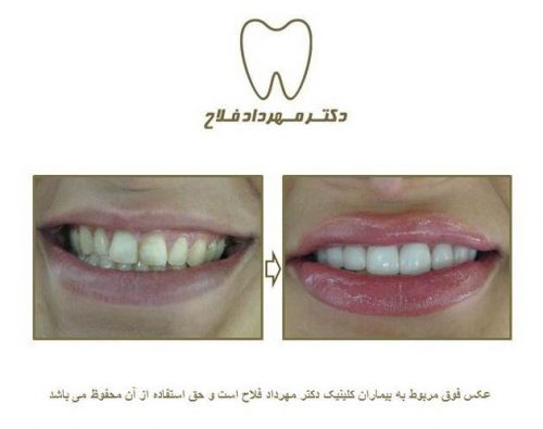 گالری عکس روکش تمام سرامیک