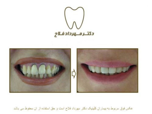 گالری عکس روکش تمام سرامیک