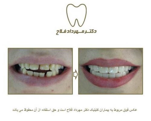 گالری عکس روکش تمام سرامیک