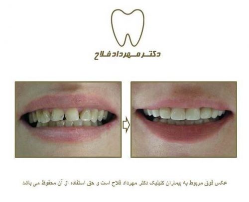 گالری عکس روکش تمام سرامیک