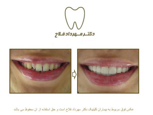 گالری عکس قبل و بعد اصلاح شکل و فرم دندان