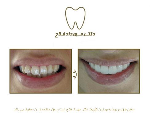 گالری عکس اصلاح نامرتبی دندان