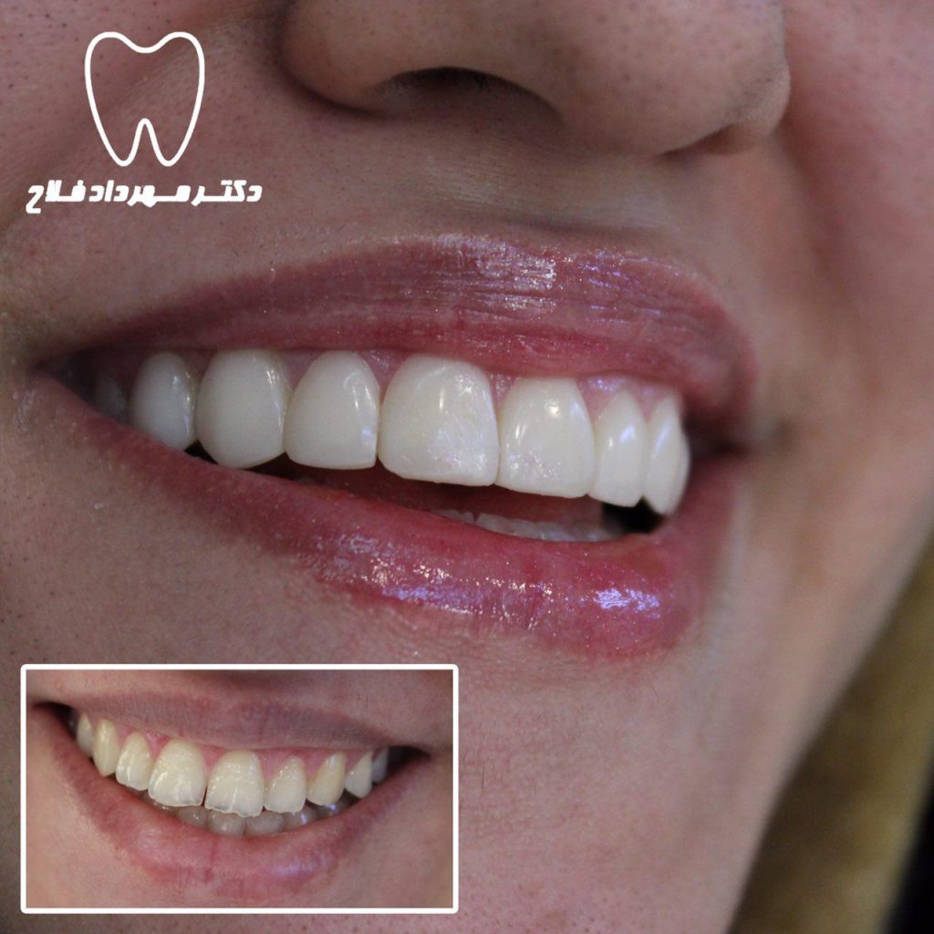عکس های اصلاح طرح لبخند