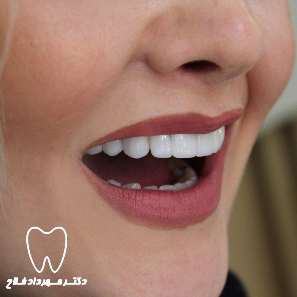 عکس های اصلاح طرح لبخند