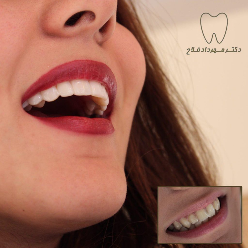 عکس های اصلاح طرح لبخند