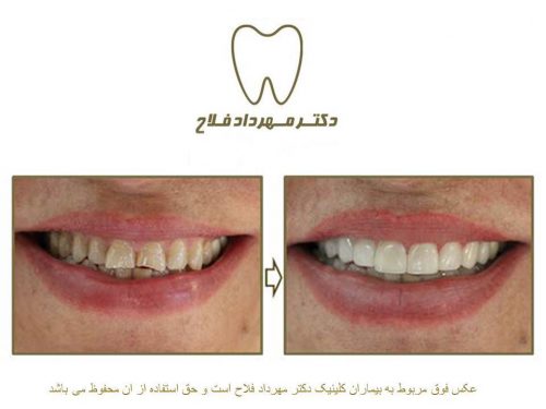 گالری عکس قبل و بعد اصلاح شکل و فرم دندان