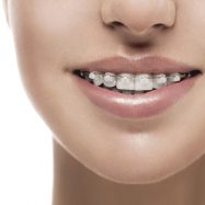 ارتودنسی سرامیکی ارتودنسی سرامیکی