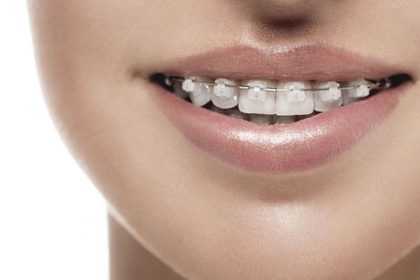 ارتودنسی سرامیکی ارتودنسی سرامیکی