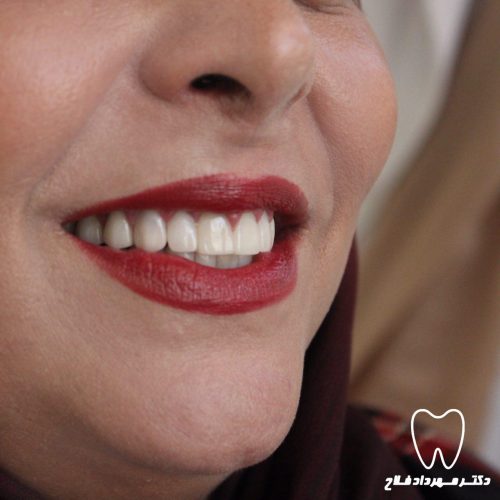 گالری عکس لامینیت