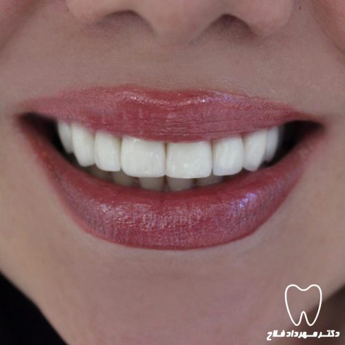 گالری عکس لامینیت