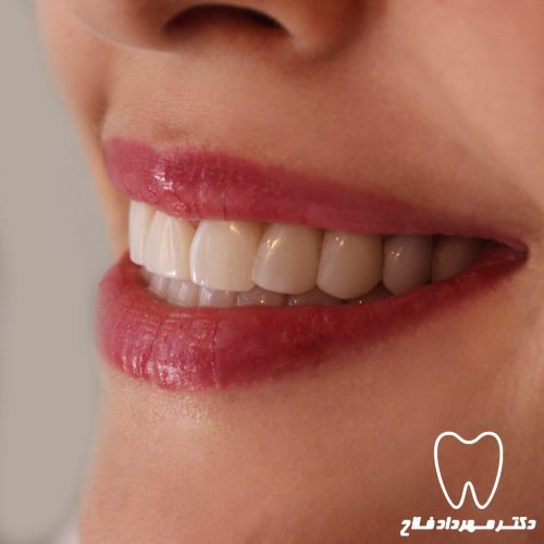 گالری عکس لامینیت