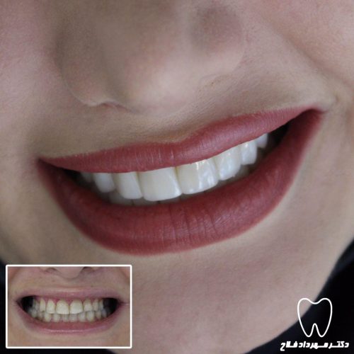 گالری عکس لامینیت