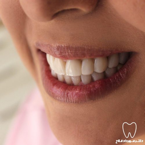 گالری عکس لامینیت