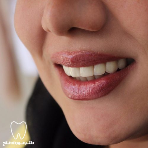 گالری عکس لامینیت