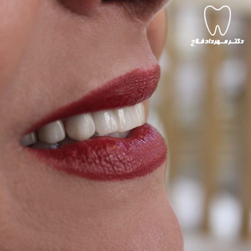 گالری عکس لامینیت