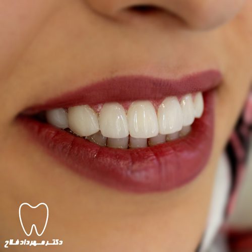 گالری عکس کامپوزیت دندان