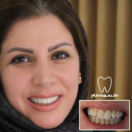 گالری عکس کامپوزیت دندان