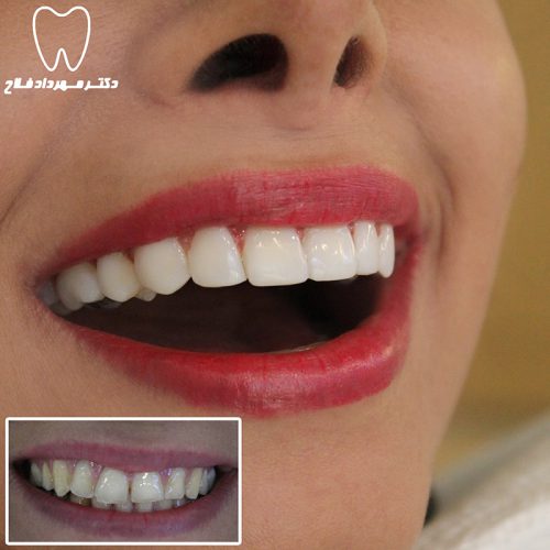 گالری عکس کامپوزیت دندان
