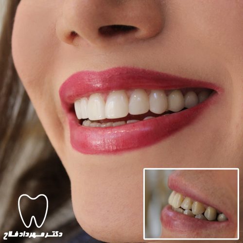 گالری عکس کامپوزیت دندان
