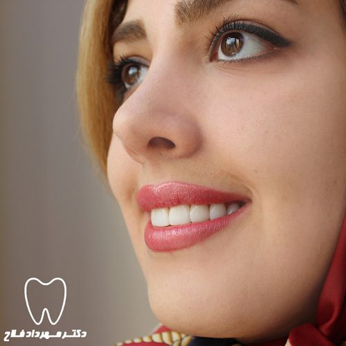 گالری عکس کامپوزیت دندان
