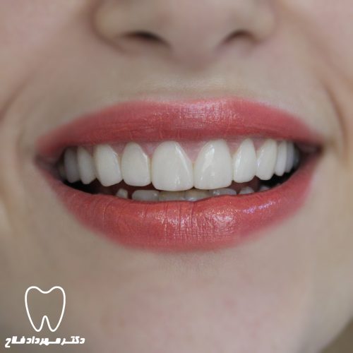 گالری عکس کامپوزیت دندان